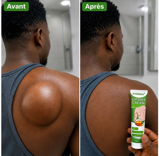 Éliminez vos lipomes et boules de graisse naturellement sans chirurgie